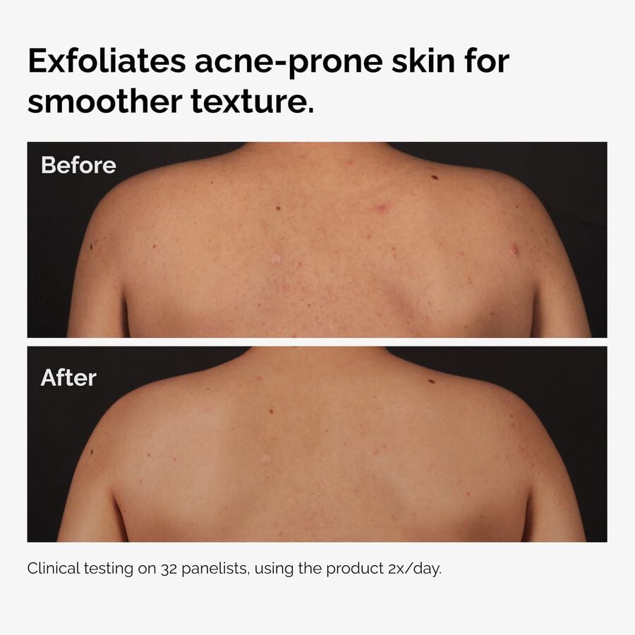 the-body-care-collection-n9 ord-salicylic-acid-body-serum-before-after-graphic-NA.jpg
