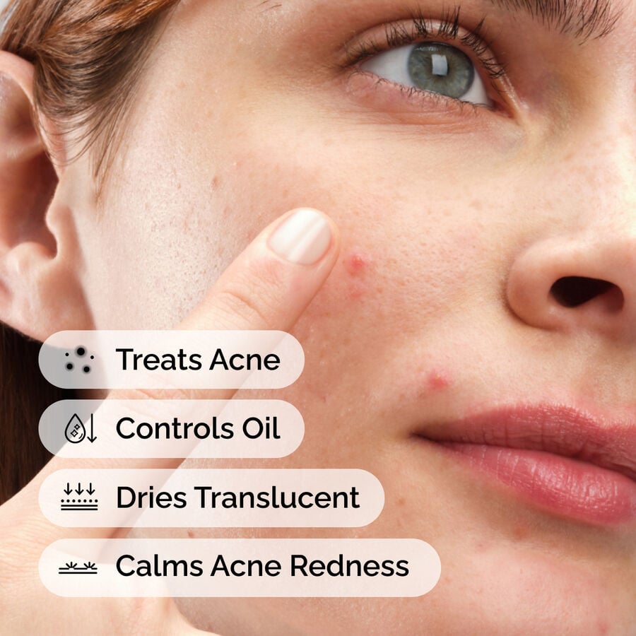 sulfur-10-powder-to-cream-concentrate-r8 ord-sulfur-10pct-powder-to-cream-concentrate-model-application-with-benefits-acne.jpg