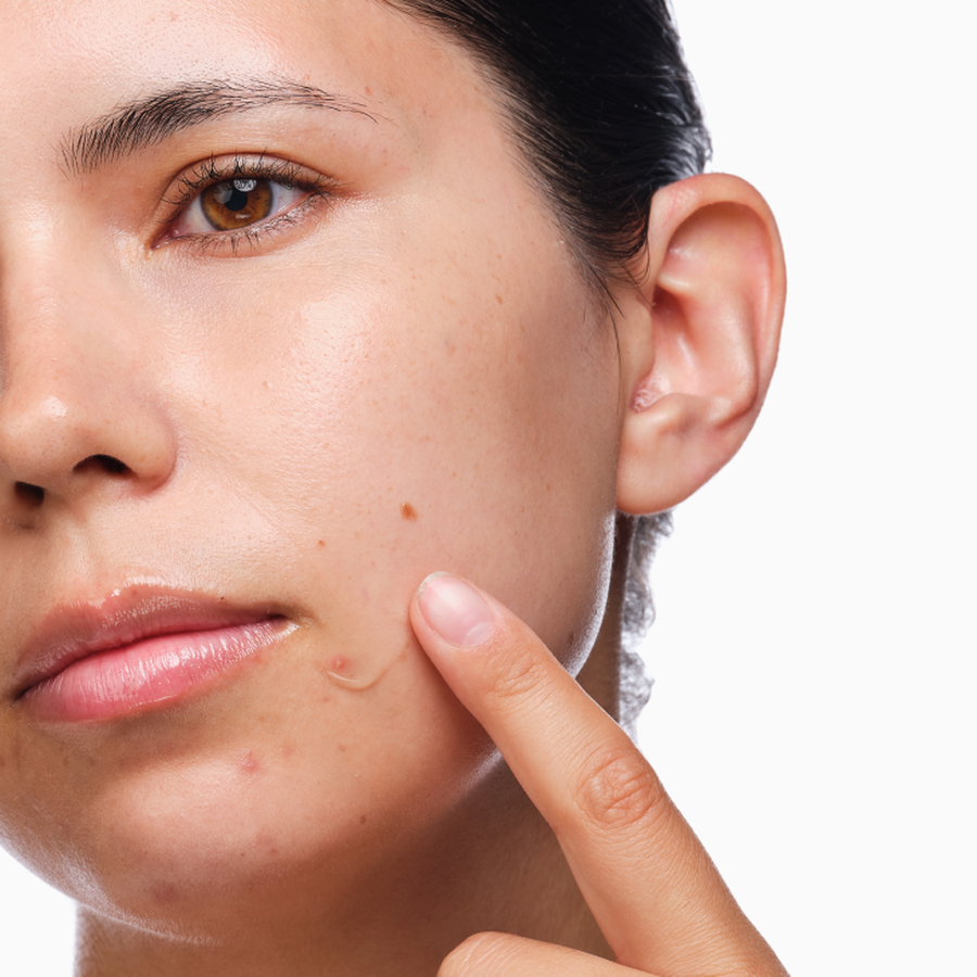 the-acne-set-q0 rdn-the-acne-set-application.png